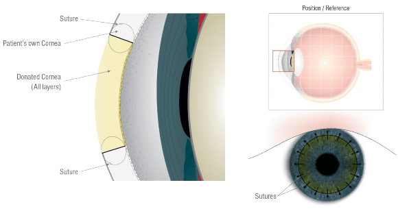 keratoplasty-eye-diagram